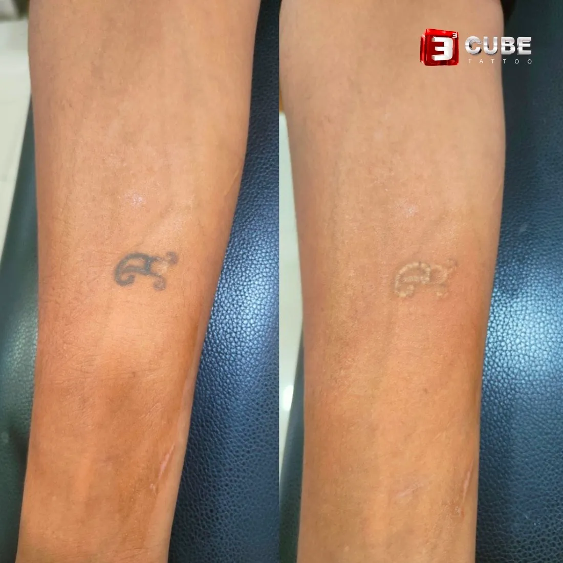 Laser Tattoo Removal Healing Process | Fairview Laser Clinic Inc.